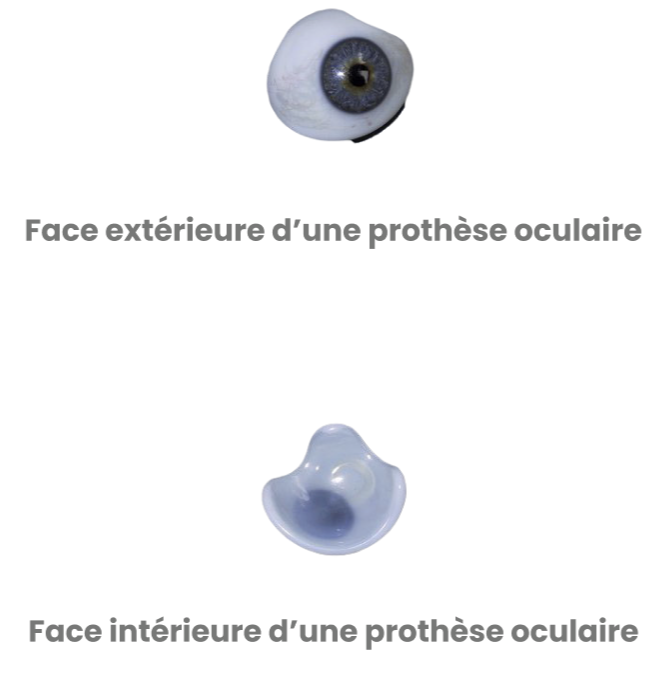 Photo de prothèse oculaire